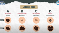 점이 아니라 피부암일 수 있다고?… 피부암 'ABCD 법칙' 꼭 기억하세요