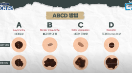 점이 아니라 피부암일 수 있다고?… 피부암 'ABCD 법칙' 꼭 기억하세요