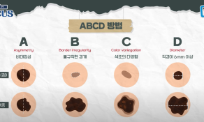 점이 아니라 피부암일 수 있다고?… 피부암 'ABCD 법칙' 꼭 기억하세요